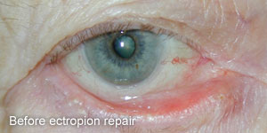 Ectropion - Before