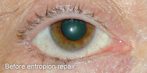 Entropion - Before